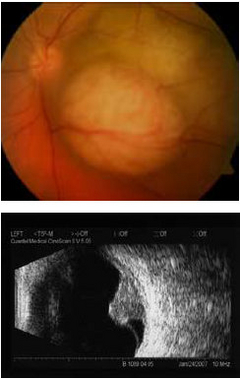 Aderhautmelanom Tumorbild vor Cyberknife