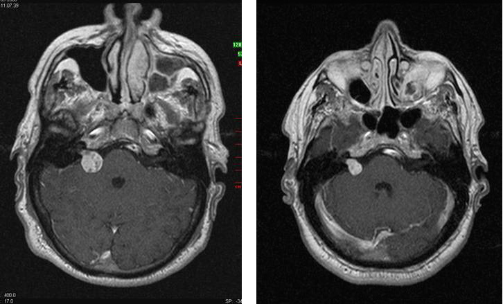 Akustikusneurinom Tumorbild